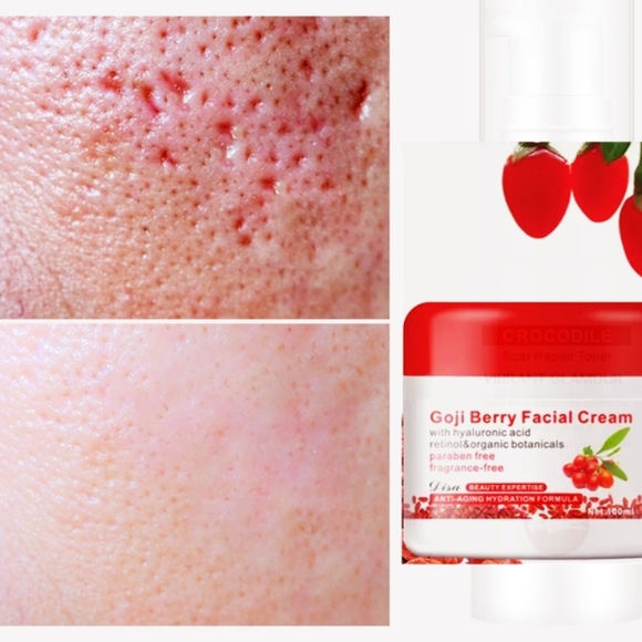 goji Other - Face Repair Scar Essence Removal Acne Scar